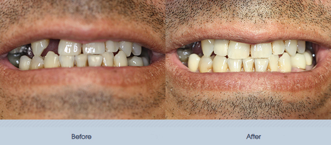 Single and Multiple Implant Restorations